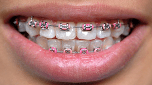 Types of Braces in Ann Arbor, MI