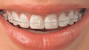 Types of Braces in Ann Arbor, MI