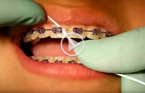 Braces video at McNamara Orthodontics in Ann Arbor, MI