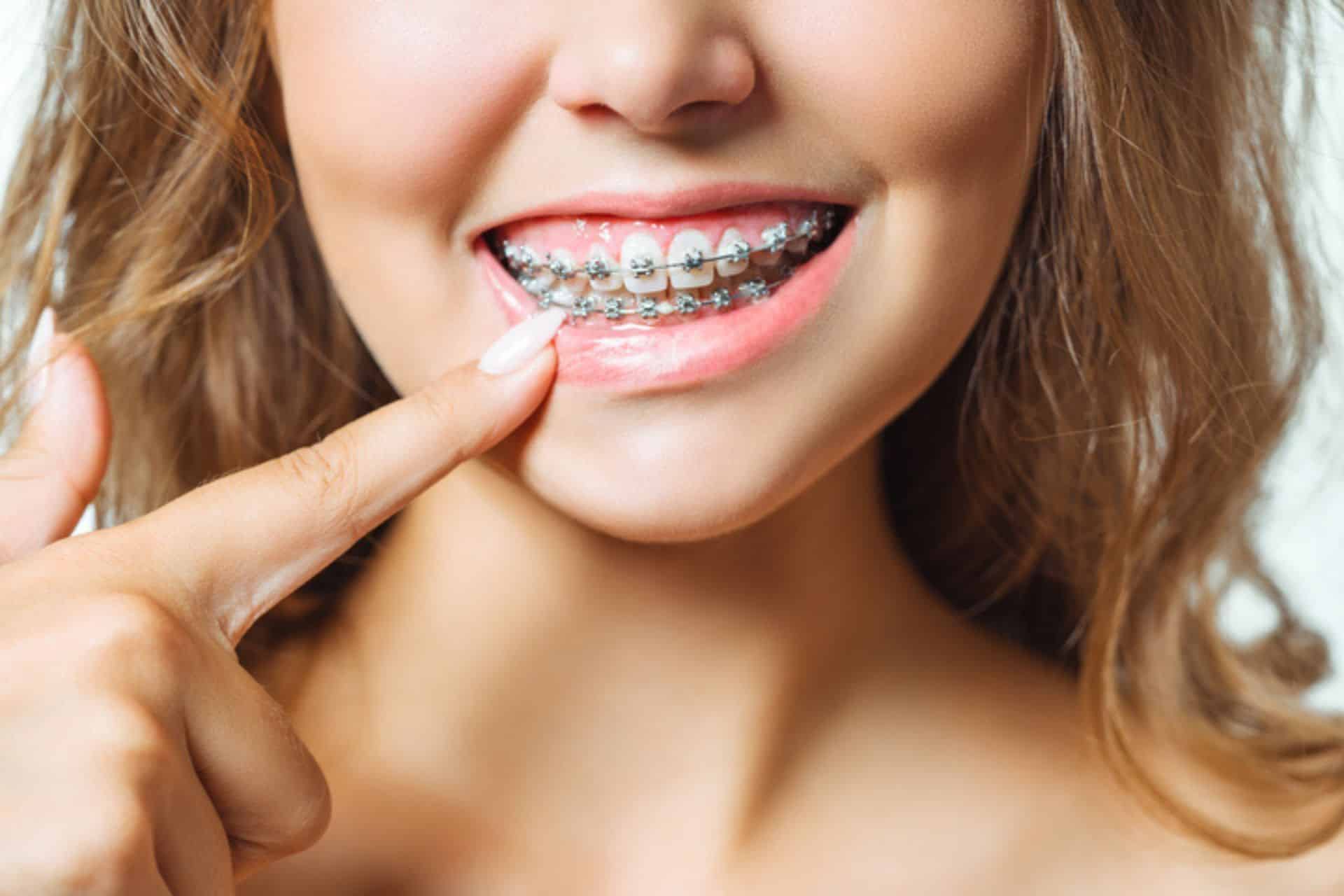 First Week With Braces: Comfort Tips McNamara Orthodontics in Ann Arbor, MI.